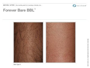 Image of BBL laser hair removal